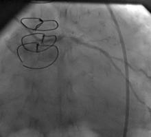 LM Restenosis Presenting with Acute MI and  VF