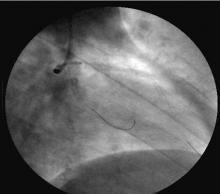 Distal LMCA Bifurcation Stenosis