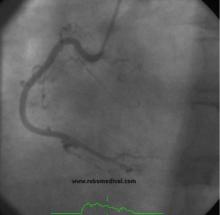 STEMI Patient with Large Thrombus in LM Treated with Full Dose Intracoronary Thrombolytic Therapy