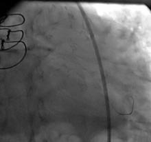LM Restenosis Presenting with Acute MI and  VF