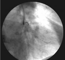 Distal LMCA Bifurcation Stenosis