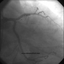 STEMI Patient with Large Thrombus in LM Treated with Full Dose Intracoronary Thrombolytic Therapy