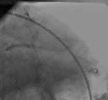 LM Restenosis Presenting with Acute MI and  VF