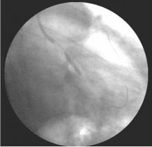 Distal LMCA Bifurcation Stenosis