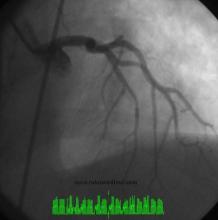 STEMI Patient with Large Thrombus in LM Treated with Full Dose Intracoronary Thrombolytic Therapy