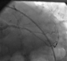 LM Restenosis Presenting with Acute MI and  VF