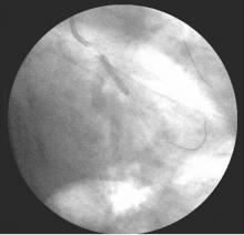 Distal LMCA Bifurcation Stenosis