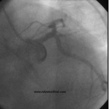 STEMI Patient with Large Thrombus in LM Treated with Full Dose Intracoronary Thrombolytic Therapy