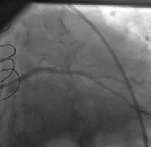 LM Restenosis Presenting with Acute MI and  VF