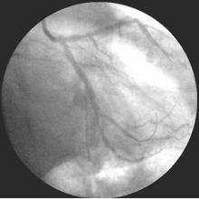 Distal LMCA Bifurcation Stenosis