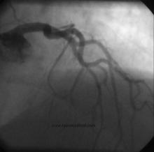 STEMI Patient with Large Thrombus in LM Treated with Full Dose Intracoronary Thrombolytic Therapy