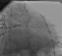 LM Restenosis Presenting with Acute MI and  VF
