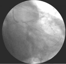 Distal LMCA Bifurcation Stenosis