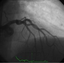 STEMI Patient with Large Thrombus in LM Treated with Full Dose Intracoronary Thrombolytic Therapy