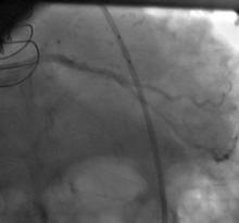 LM Restenosis Presenting with Acute MI and  VF