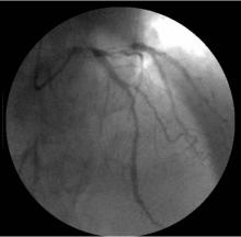 Distal LMCA Bifurcation Stenosis