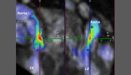 Four-Dimensional Flow CMR Shows Promise in Aortic Stenosis