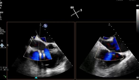 CMS Agrees to Reimburse Tricuspid TEER
