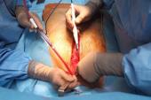 The ART of CABG: Bilateral Technique Associated With Similar Outcomes as Single Graft at 5 Years