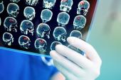 Two New Trials Buoy Outlook for PFO Closure in Patients With Cryptogenic Stroke