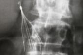 Inferior Vena Cava Filter Use Fell After FDA Warning but Remains High