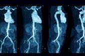 Incidental Findings on CT Angiography Predict All-Cause Mortality Following TAVR