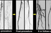 Lower Limb Revascularizations Increasing in PAD Patients on Dialysis