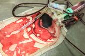 TRICS III: Restrictive Red-Cell Transfusion Noninferior to Liberal Use in Cardiac Surgery