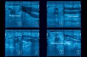 Attacking DVT With Drug-Device Combo Does Not Reduce Postthrombotic Syndrome 