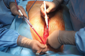 Largest Study to Date Supports Surgical LAA Closure in A-fib Patients