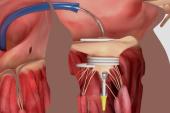 Early Results for Dock-Plus-Valve Approach Promising in Transcatheter Mitral Valve Replacement
