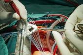 New Surgical Valve Durability Data Set ‘Critical Benchmark’ for TAVR Devices