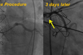 Delayed Coronary Obstruction After TAVR: Prevalence, Causes, and Solution Explored for Deadly Complication