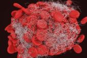 Thrombus on the Watchman LAA Occluder Tied to Higher Stroke Risk
