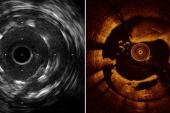OCT, IVUS Each Boost Long-term Outcomes When Used to Guide PCI, Study Suggests