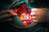 STS Data: Mitral Valve Cases Are Fastest-Growing Surgical Intervention in North America