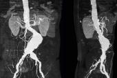 FDA: All AFX Endovascular AAA Systems Now Under Class I Recall 