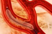 New-Generation DES Better Than Older Stents Over 10 Years, Regardless of Polymer Type