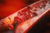 ‘Accelerated Atherosclerosis’ Not Uncommon in Arteries of Young People 