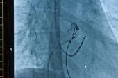 Catheter Ablation Boosts Outcomes in Patients With A-fib and Heart Failure: Meta-analysis