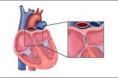 Late Follow-up of PFO Closure for Stroke Raises Questions for Antiplatelet Duration