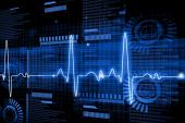 Artificial Intelligence From ECGs May ID Asymptomatic LV Dysfunction 