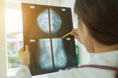 Breast Calcifications May Hold Important Clues for CV Risk Stratification