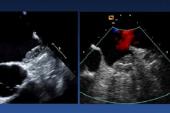 Device-Related Thrombus and LAA Closure: Rare but Dangerous