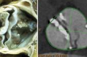 Similar Mortality, Higher Early Stroke Risks in TAVR for Bicuspid Aortic Stenosis 