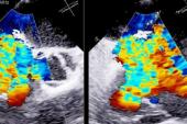 Pascal Transcatheter Device Safe, Improves Tricuspid Regurgitation: Early Results