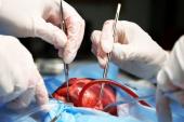 Meta-analysis Supports Surgical LAA Occlusion During Cardiac Surgery, but Flaws Found