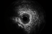 IVUS-XPL at 5 Years Shows Durability of Imaging Guidance in PCI