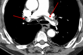 Overuse of CT Scans for Suspected Pulmonary Embolism Persists