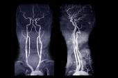 Stroke Thrombectomy for Basilar Artery Occlusions Gains Support: Registry